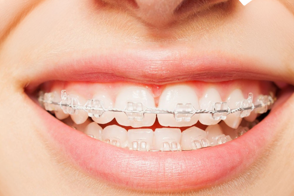 Ceramic-Braces