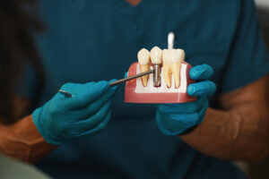 Dental Implant in NOIDA 122