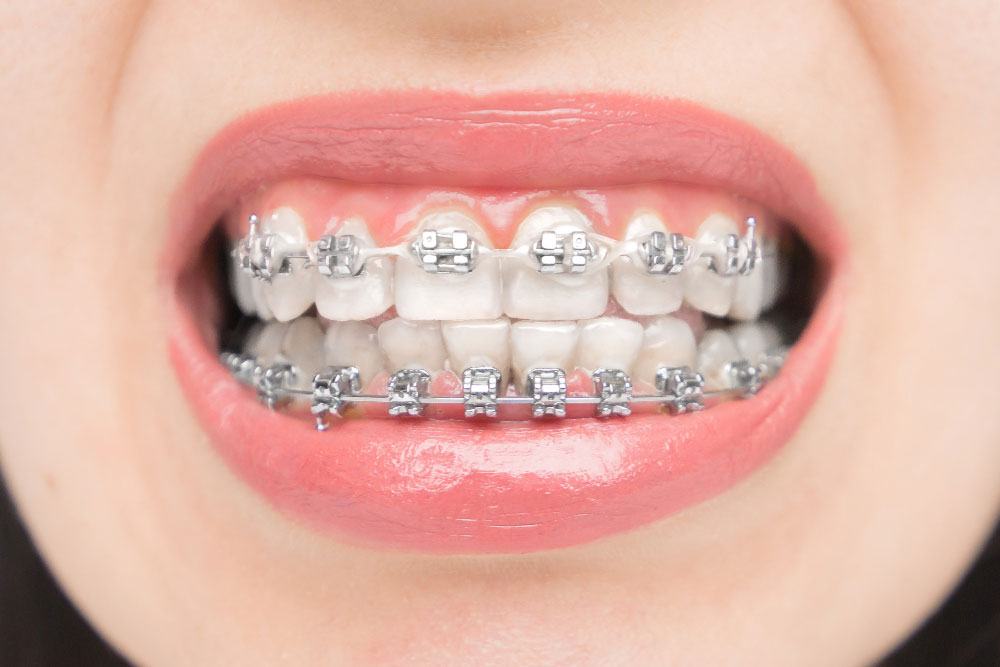 Self-Ligating Braces