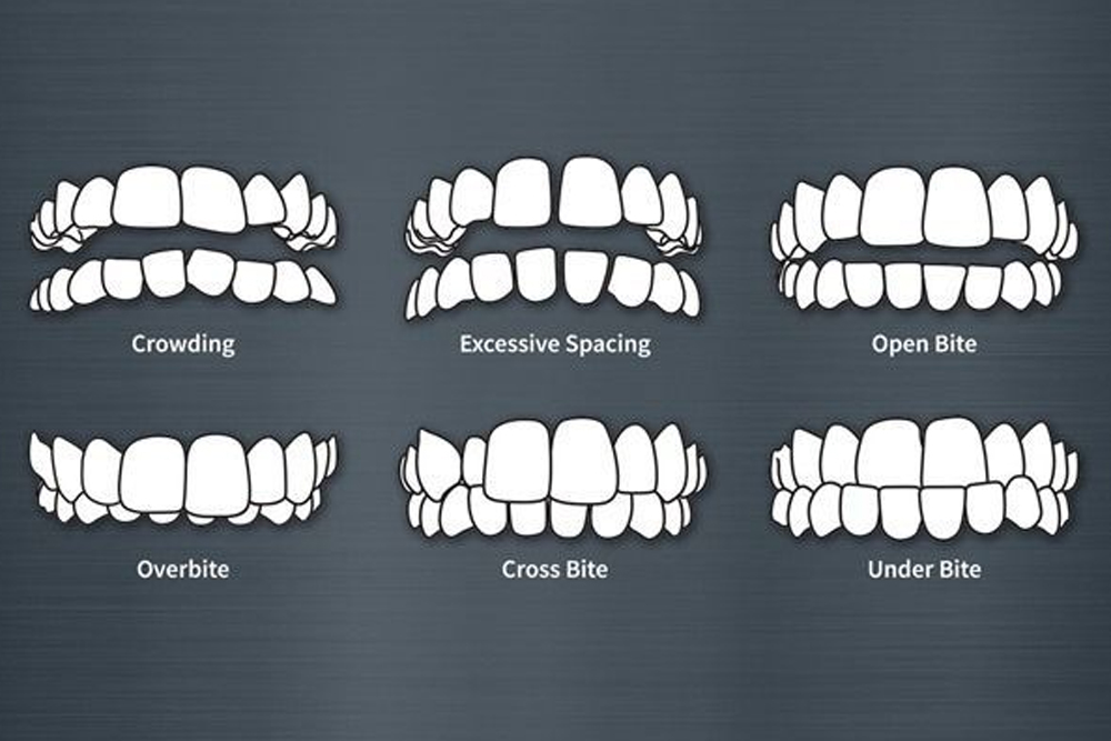 Braces in NOIDA